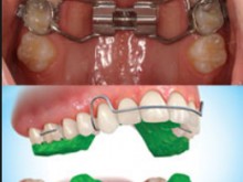 Disgiuntore del palato e apparecchio dento posturale