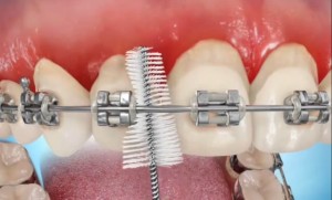 lo scovolino è molto utile anche in ortodonzia
