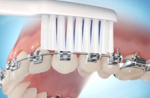 tecnica per spazzolare i denti con apparecchio ortodontico