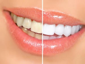 SBIANCAMENTO dei denti foto prima e dopo