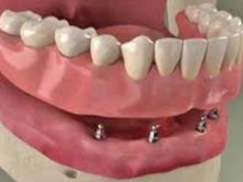 Mini impianti dentali