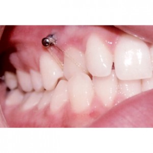 Mini impianto dentale e Ortodonzia studio dentistico Chioggia e Cavarzere